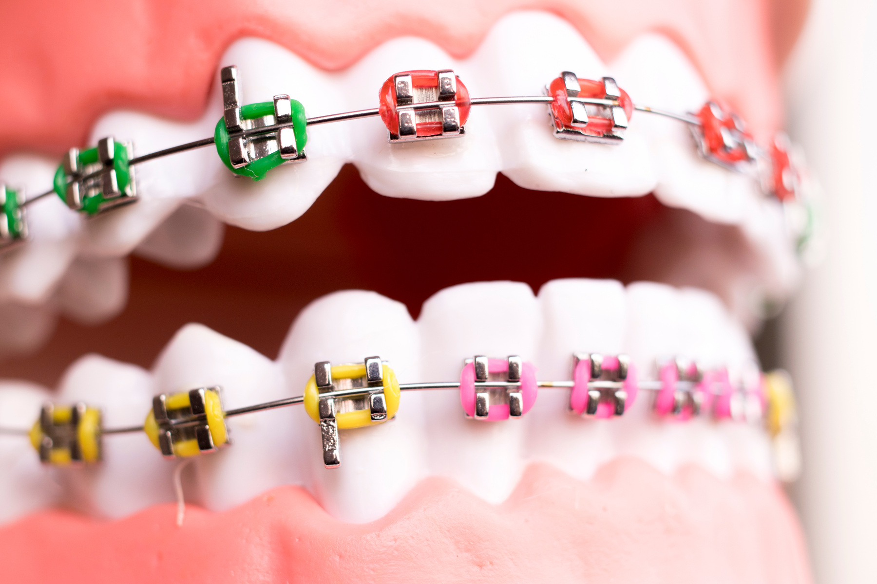 Dental Metal Brace Orthodontics Model